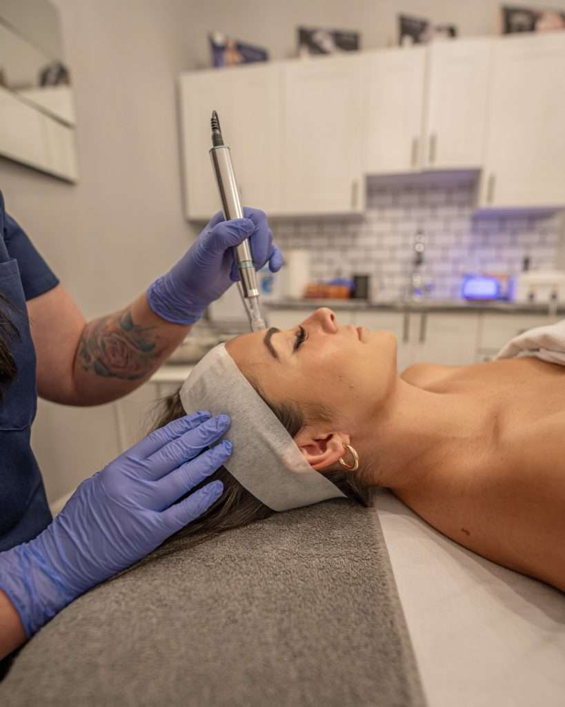 TWIST Microneedling treatment at Ciao Bella